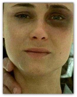 Human Trafficking - individual with black eye